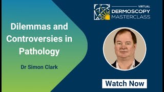 Dilemmas and Controversies in Pathology - Dr Simon Clark - Virtual Dermoscopy Masterclass 2020