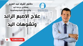 الاصبع الزائد وتشوهات اليد / دكتوراشرف عبد العزيز