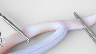 3D Medical Animation | Vascular Graft Performance Simulation