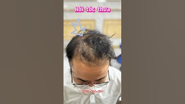Cách tạo kiểu tóc cho ae tóc thưa, hói đỉnh , vnscalp đẳng cấp vượt biên giới #xămtóc
