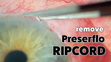 Remove Preserflo Ripcord at slitlamp (10-0 Nylon)