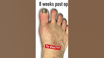 Bunion Surgery before and after.No scar! Crazy!🤯 #shorts #bunion