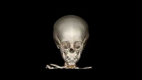 3D movie showing surface shaded display of craniofacial anatomy