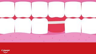 The Four Types of Dental Bridges