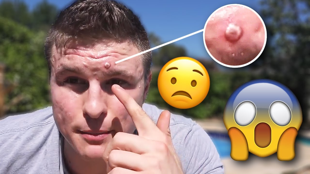 Every Person Suffering From Acne Needs To See This...