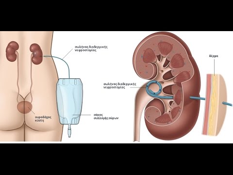 Τοποθέτηση διαδερμικής νεφροστομίας