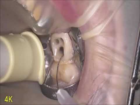 Sinus tract　サイナストラクトのある根管治療　Opelaser Filio