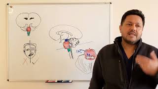 Bell's Palsy (4) - Recurrent or Worsening Symptoms and the Differential Diagnosis