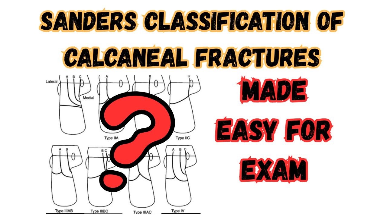 Sanders Classification Hand Descriptive Sanders Classification for Calcaneal Fractures : Made EASY for EXAM ...
