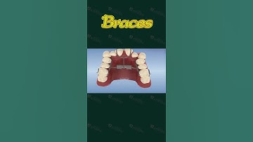 [3D] BRACES || Nha Khoa Quốc Tế Athena