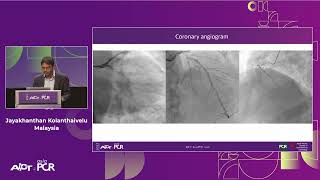 Leave nothing behind: DCB-only PCI strategy - How #DCB evidence has changed today's practice?