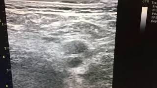 Femoral Access with Ultrasound