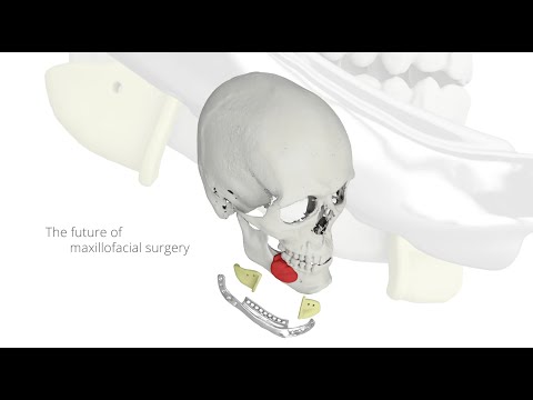 Planmeca ProModel – patient-specific medical implant design