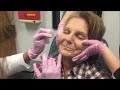 Volbella Filler Part 2