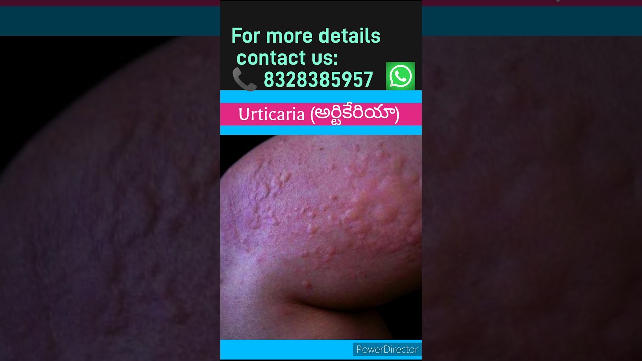 urticaria (అర్టికేరియా) 