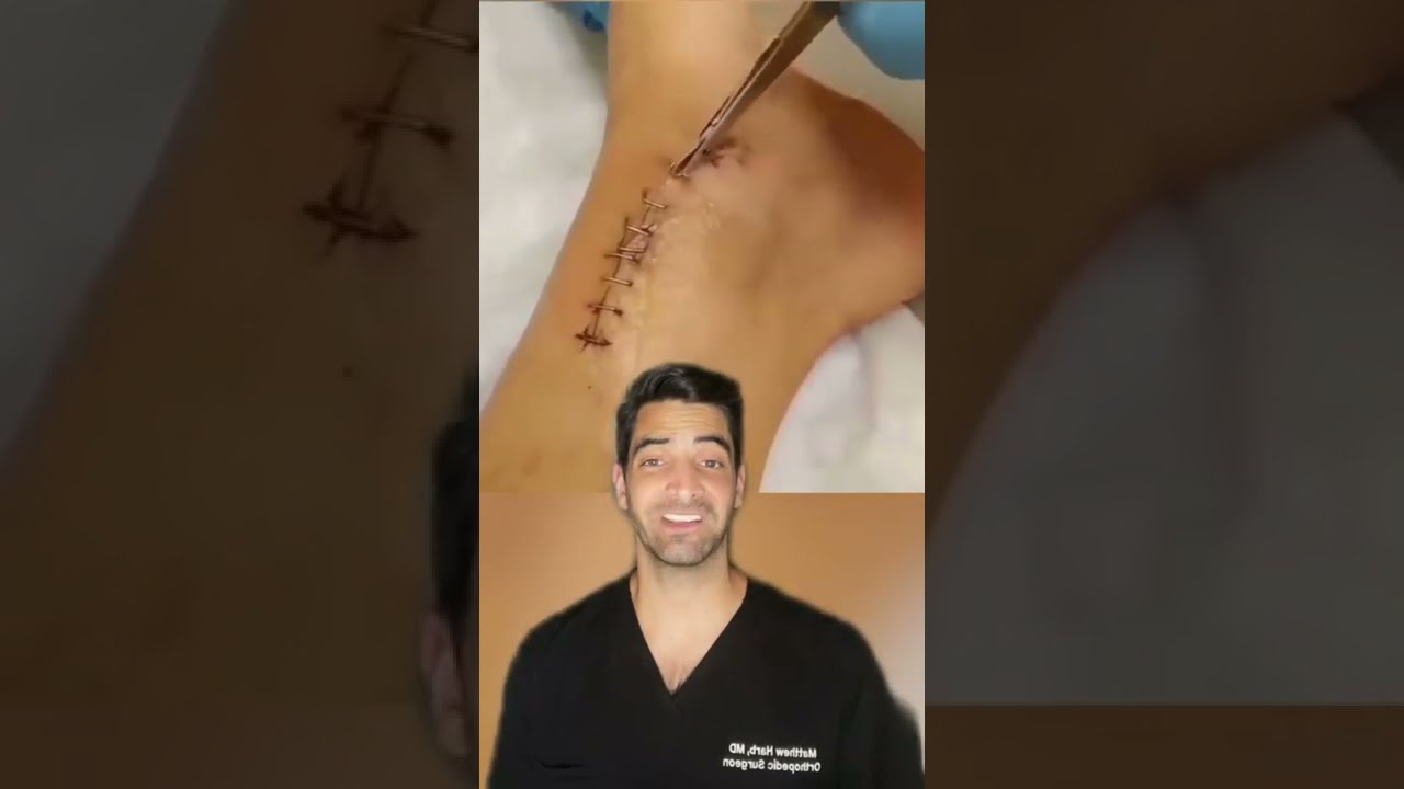 Staple Removal