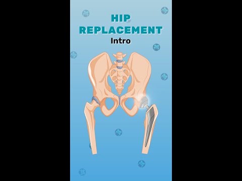 Are you considering hip replacement surgery ? This video series is a ...
