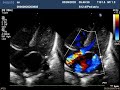 Ехо КГ з аналізом  аортальний стеноз новонародженого