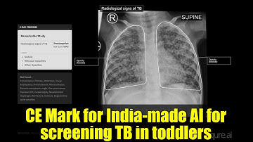 CE Mark for India-made AI for screening TB in toddlers