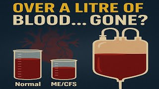 Blood Volume Loss in ME/CFS: What the Research Reveals Blood Plasma Levels Low