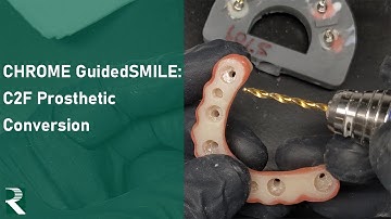 CHROME GuidedSMILE: C2F CHROME Prosthetic Conversion