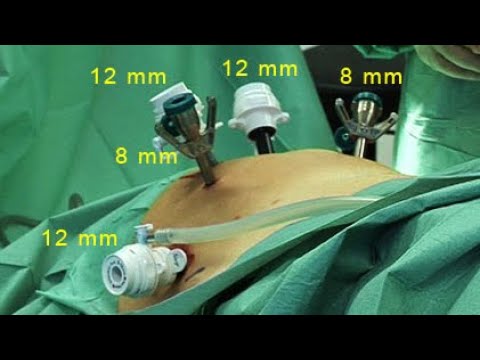 Robot-assisted radical prostatectomy; robot-assisted surgical removal of the prostate