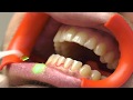 Finest Professional Tooth Cleaning with different Laser Systems