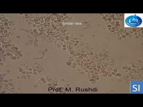 Pyuria Pus Cells In Urine 2 Youtube