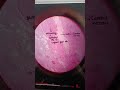 #TB LYMPH NODE