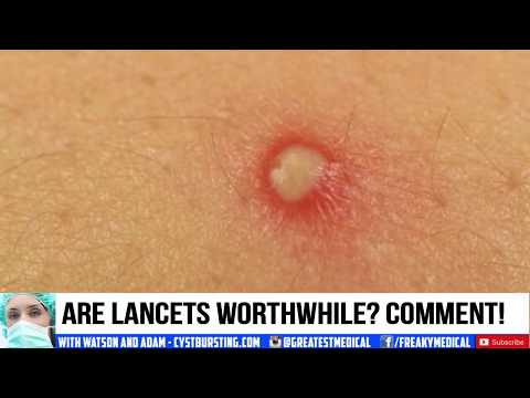 Popping Pimples & Cystic Acne with Lancets