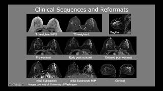 New update : Breast MRI