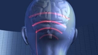 Migraine study says nerve stimulation could bring relief