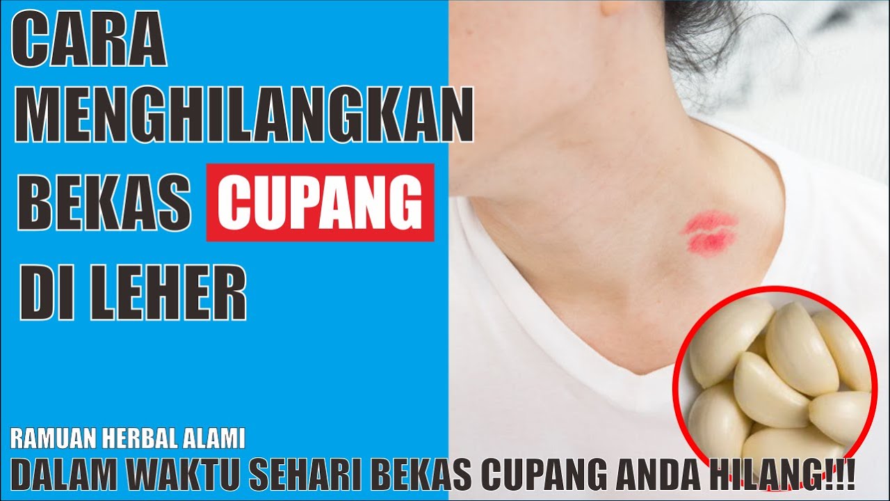 Cara Menghilangkan Bekas Cupang di Leher dengan Bawang ...