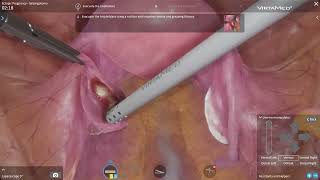 Virtamed Laparos - Ectopic Pregnancy