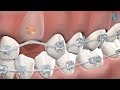 Guided Eruption of Impacted Teeth in Fresno CA: Dr. Greg | Nalchajian Orthodontics