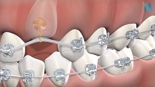 Guided Eruption Of Impacted Teeth In Fresno Ca Dr. Greg Nalchajian Orthodontics