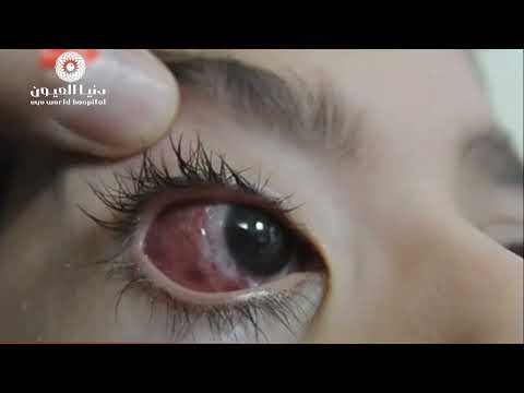 اصابات سطح العين 