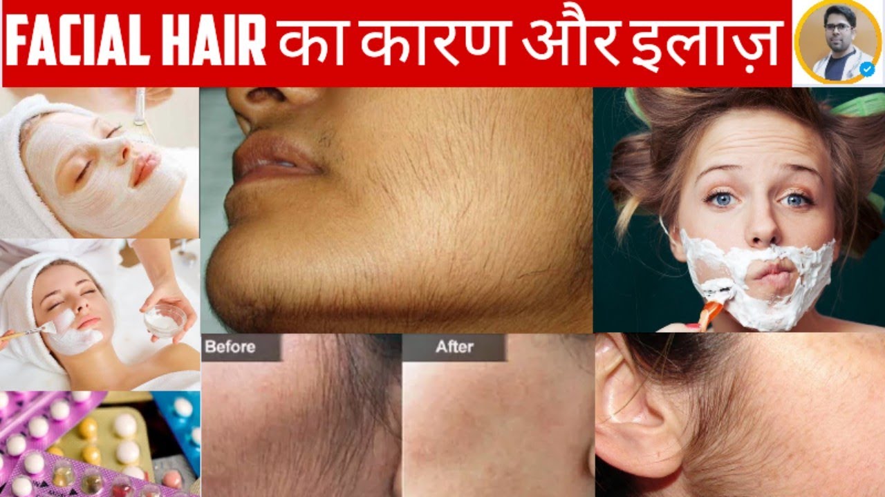 चेहरे के बालों का कारण और इलाज़/FACIAL HAIR TREATMENT IN HINDI/चेहरे के