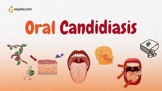Oral Candidiasis | Dentistry | Causes, Classification, Pathogenesis, Treatment