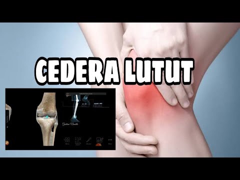 Video: Performa Satu Kaki Dan Kinematika Lutut Terkait Pada Orang Yang Kekurangan ACL Dan Yang Direkonstruksi ACL 23 Tahun Pasca Cedera
