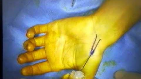 Percutaneous scaphoid # mpg1