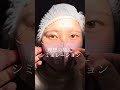 【二重整形シュミレーション】左右差のある二重の幅を整える!