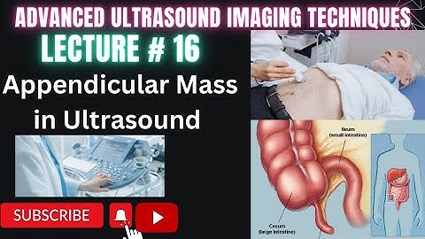 How to do Appendix Ultrasound Part 4 Appendicular Mass in ultrasound #ultrasound#technology#medical