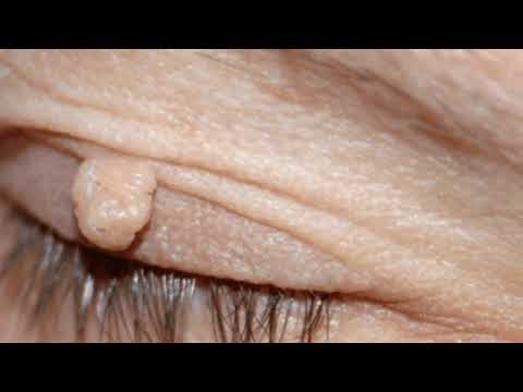 Video: 3 mënyra për të hequr lythat në fytyrë