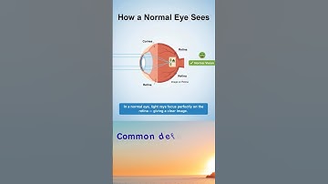 Ch-10-CBSE Physics Class 10 Most Important Common defects of the human eye  Myopia and Hypermetropia