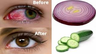 Eat this two for stronger sight never wear glasses again