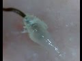 #1 超スッキリ!ぷるっぷるの毛根鞘取れた!(Pull out hair root & root sheath)