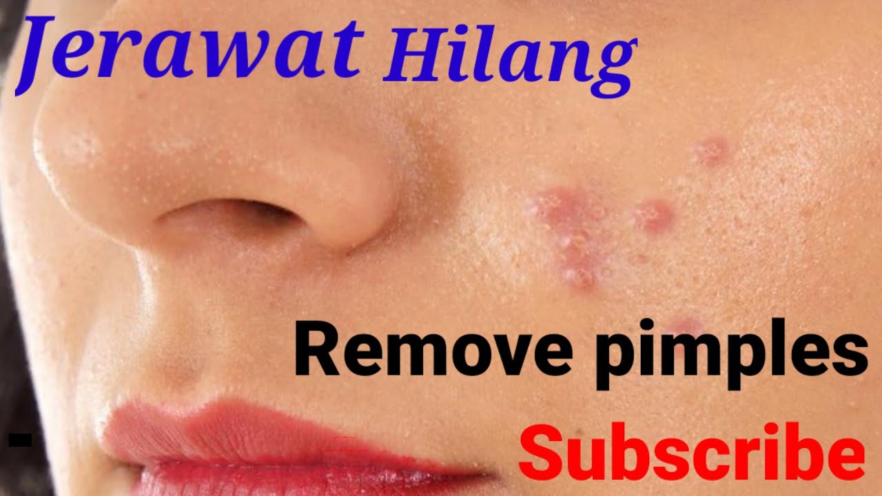 #jJerawat#Pimples#Berminyak Cara menghilangkan bekas jerawat hitam