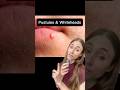 The TRUTH About Whiteheads #dermatologistadvice