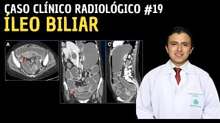 Caso Clínico 19: Íleo biliar. Caso Clínico 19: Íleo biliar.